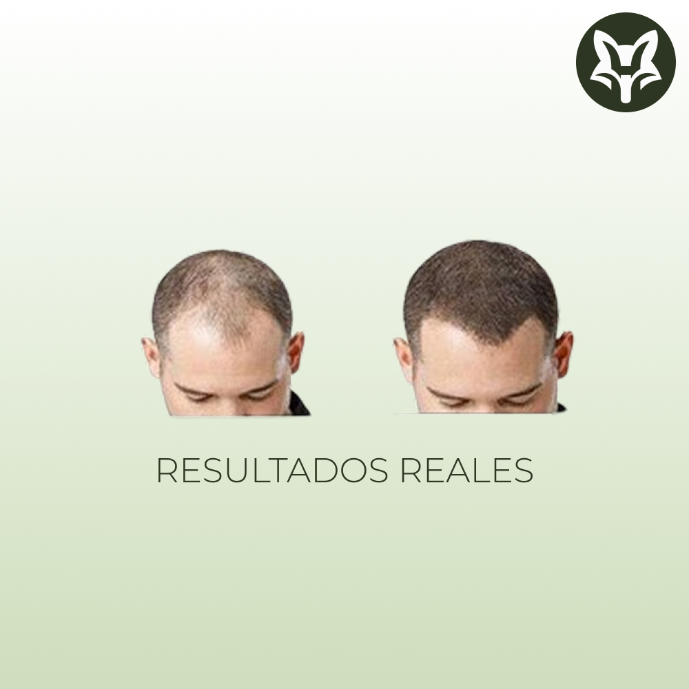 Derma Roller System – 540 Microagujas